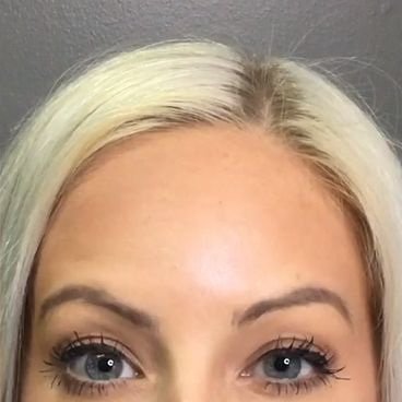 Alın Botoksu Fiyatı | WWW İstanbul