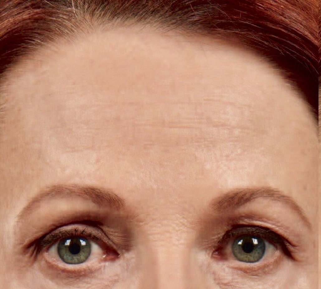 Alın Botox Fiyatı | WWW İstanbul